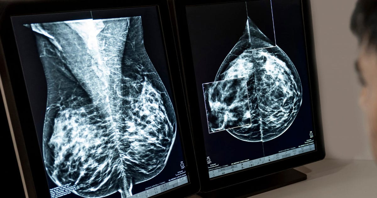 AI tool could predict breast cancer risk over next 4 years